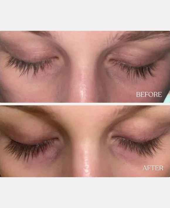 Vippeserum